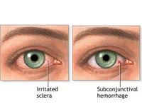 Govt.  Compensation to  eye  victims 