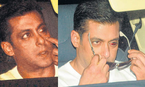 Salman undergoes surgery for younger look