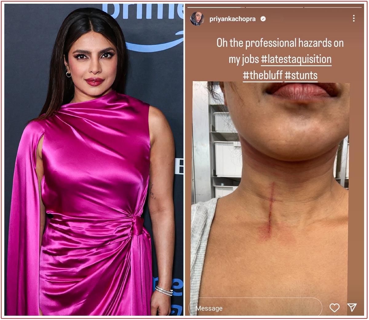 Priyanka posting a picture showcasing the injury on her throat